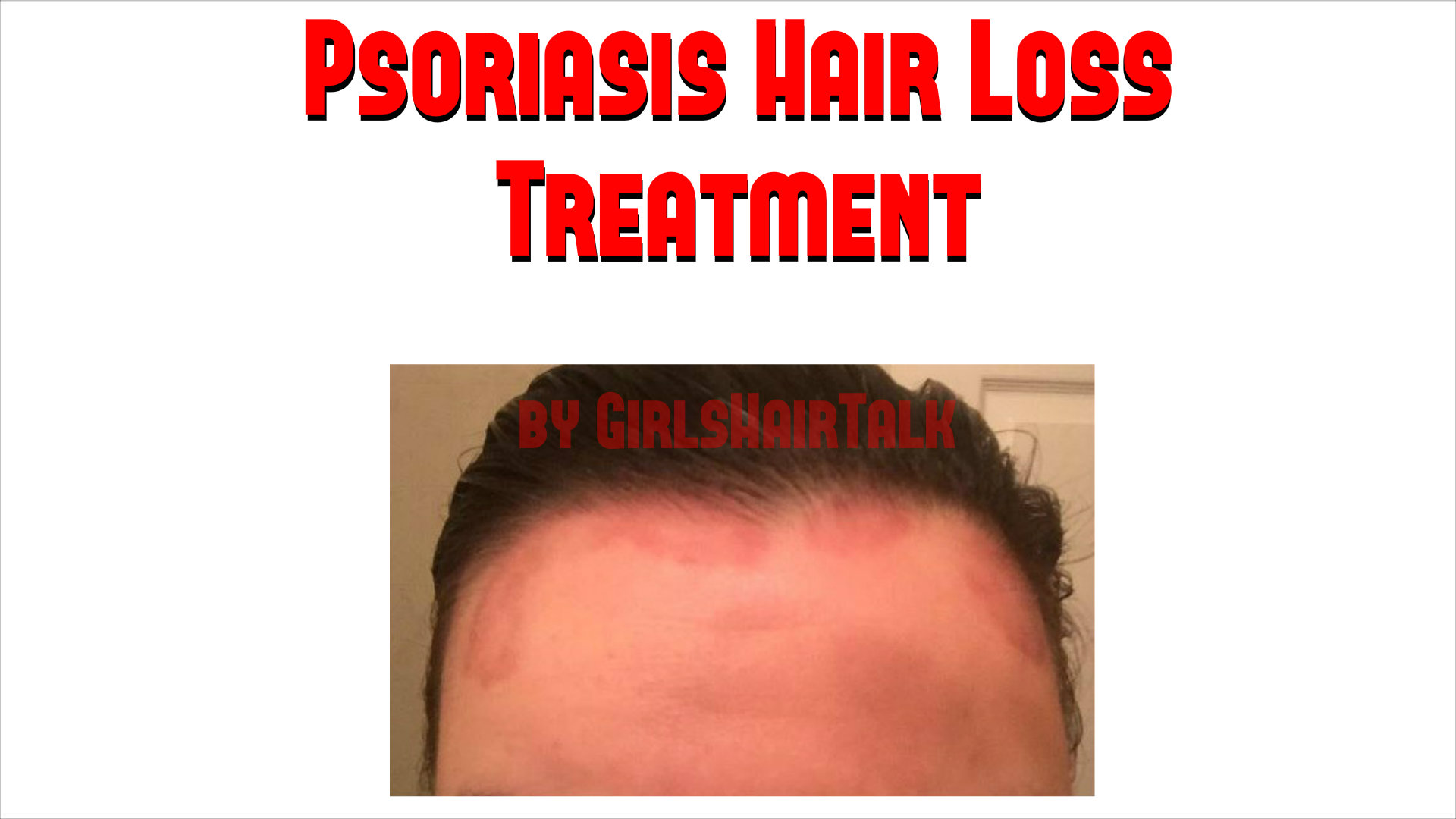 psoriasis-hair-loss-treatment-to-get-hair-regrowth-at-home-fast